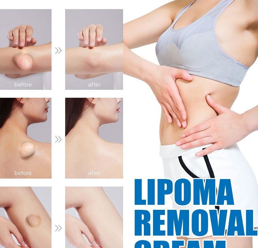 Lipoma Removal Cream