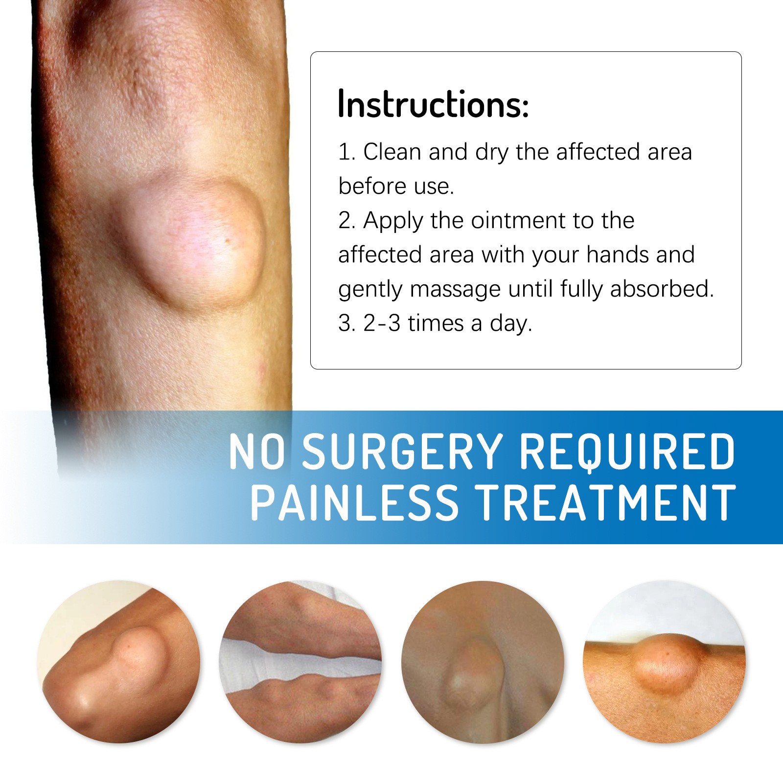 Lipoma Removal Cream