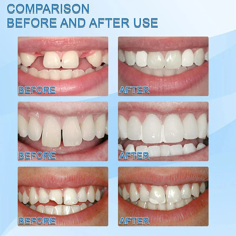 Kit de reparación de dientes temporales moldeables