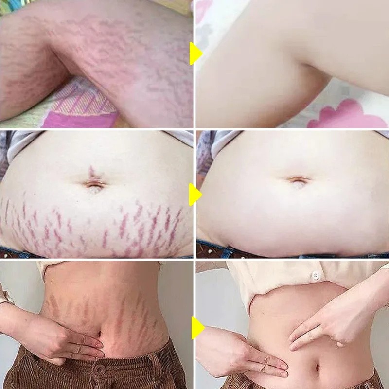 Crema para eliminar estrías de forma permanente: cuidado reafirmante y reparador de la piel