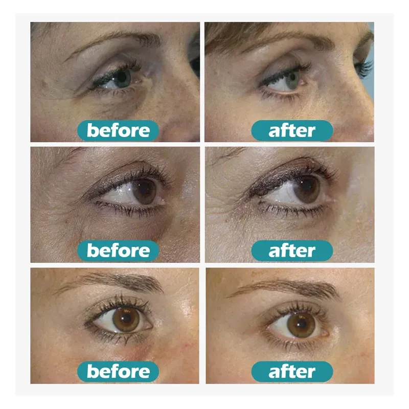 Gel reparador de bolsas de ojos Fade Eye Pattern Care