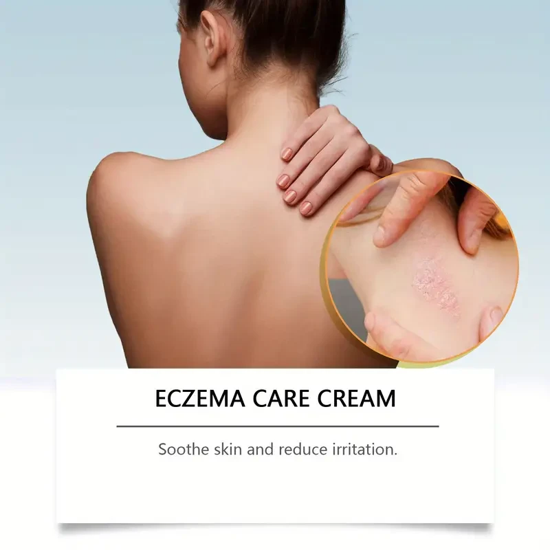Crema para el eczema con veneno de abeja: alivio calmante e hidratante para todo tipo de piel