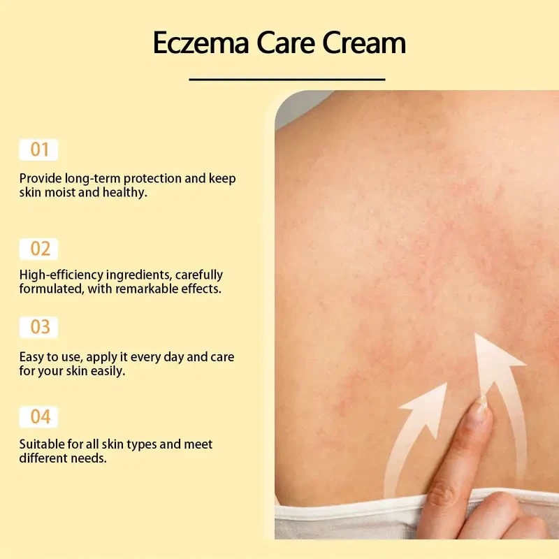 Crema para el eczema con veneno de abeja: alivio calmante e hidratante para todo tipo de piel