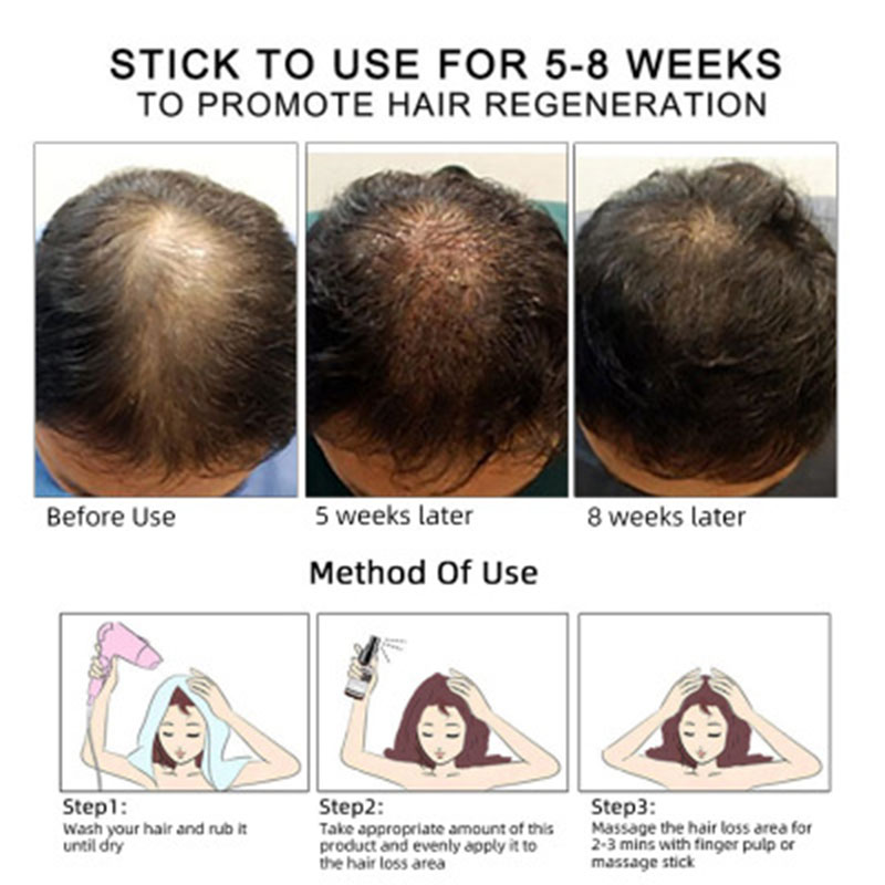 Aceite para el crecimiento del cabello Aceite para el crecimiento del cabello Aceite esencial OEM para el cuidado del cabello