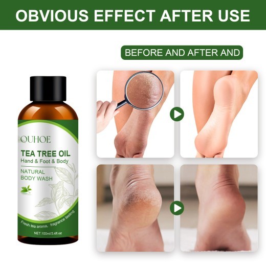 Solución exfoliante para el cuidado de la piel y las grietas en los callos del talón.