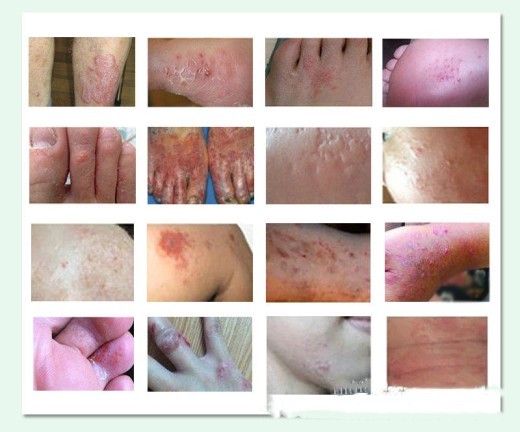 Cuidado de la piel con picazón Loción para el cuidado de la piel