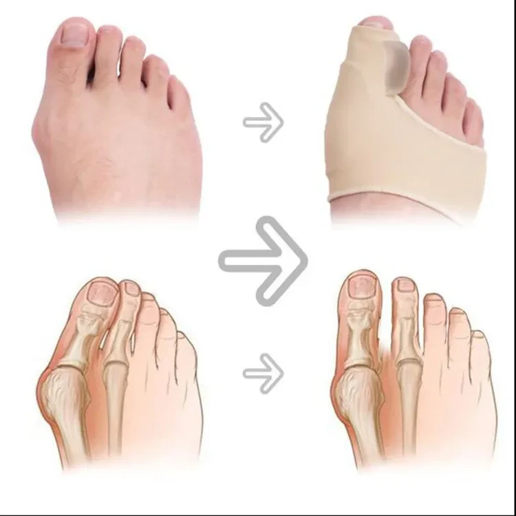 Corrector de valgo para pies grandes: use una funda protectora