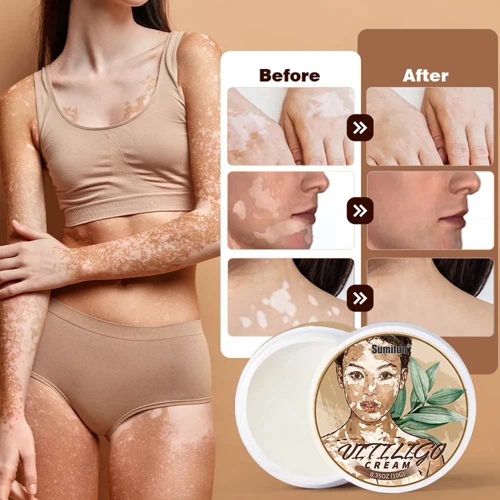 Crema antibacteriana para manchas blancas y piel blanca