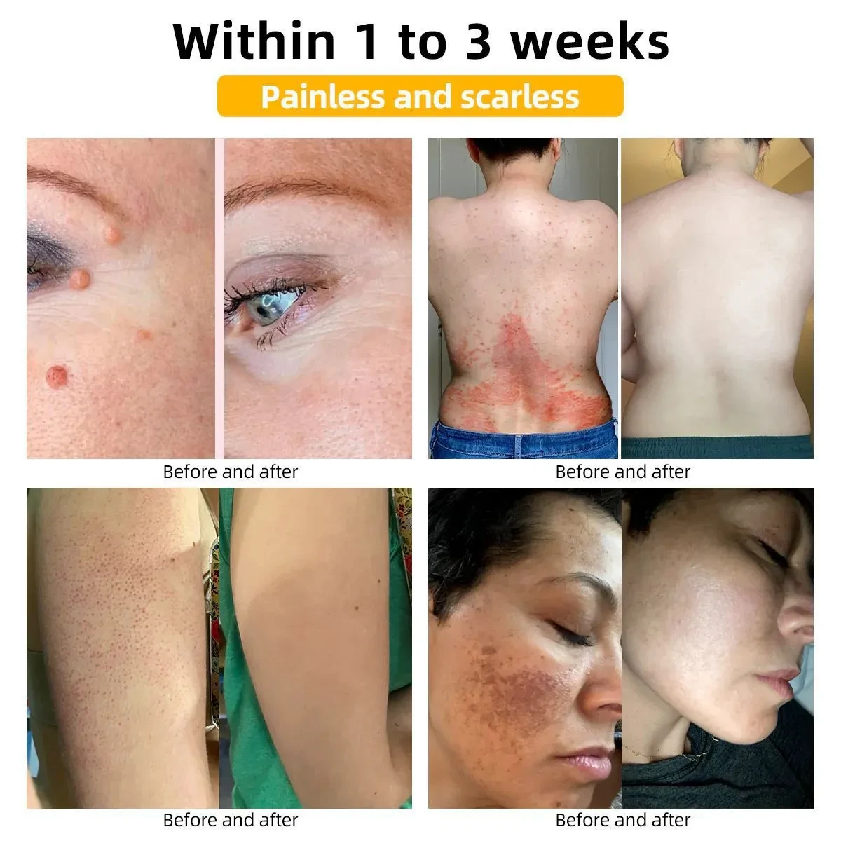 Crema para lunares y verrugas que aclara la piel, limpia y repara