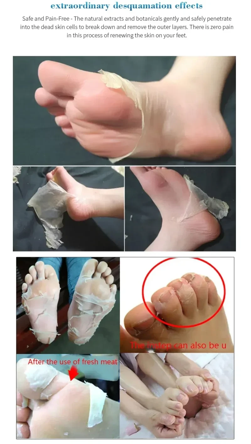 Blanqueamiento de talones, peeling de pies, cuidado de la piel antigrietas.