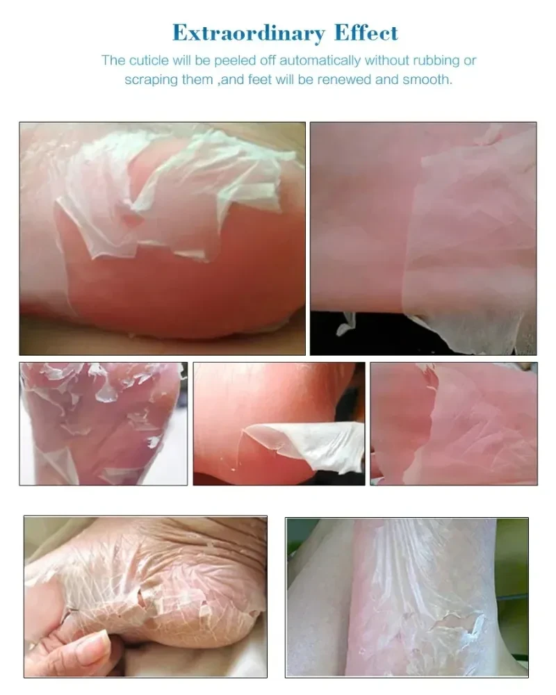 Blanqueamiento de talones, peeling de pies, cuidado de la piel antigrietas.