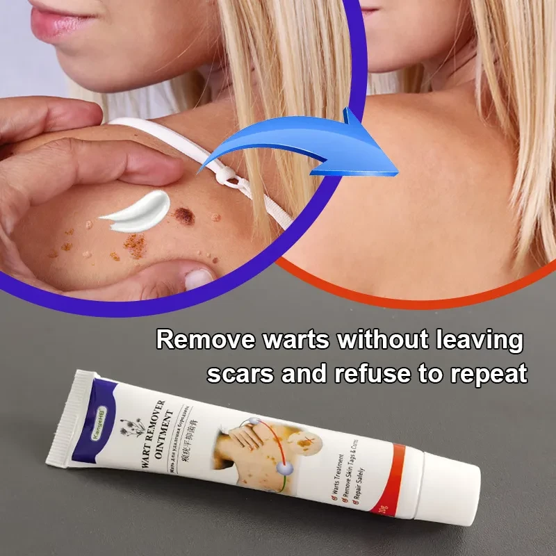 Crema para eliminar verrugas Wart Flat Monkey You