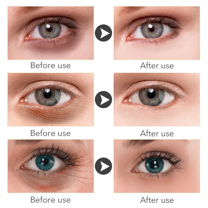 Crema gel antihinchazón para eliminar bolsas de ojos al instante