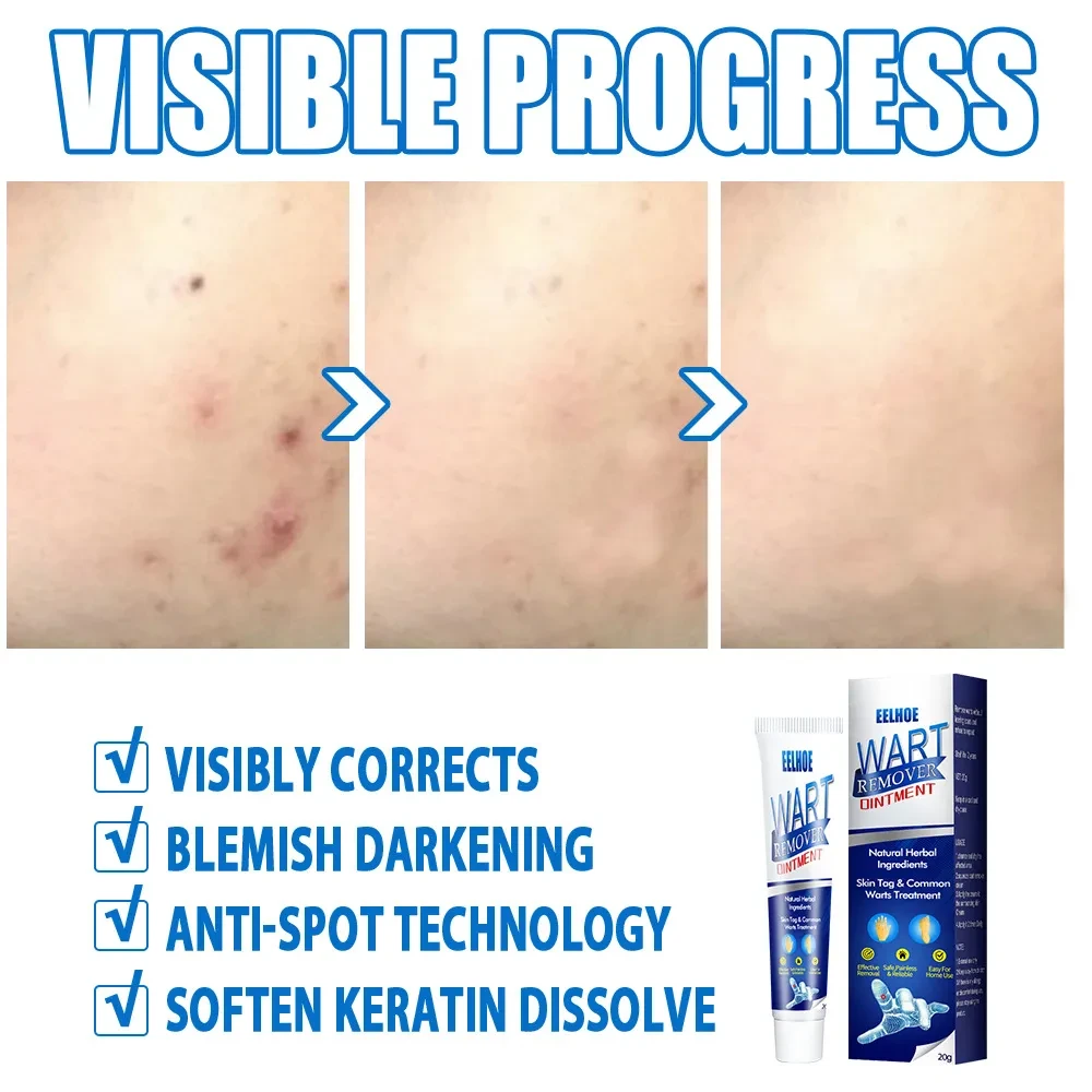 Loción para el cuidado de la piel común Liquid Skin Warts