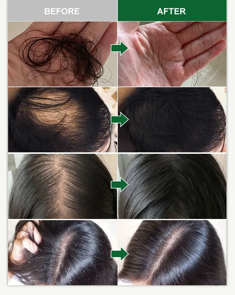 Cuidado del cuero cabelludo con romero y jengibre