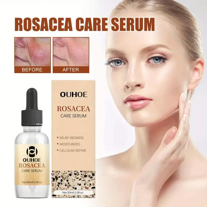 Suero para la rosácea OUHOE, 60 unidades, cuidado facial, aceites esenciales, hidrata y nutre, reduce el enrojecimiento de la piel, calma y elimina la piel escamosa, apto para todo tipo de piel, con glicerina, árbol de té, aloe vera y urea.