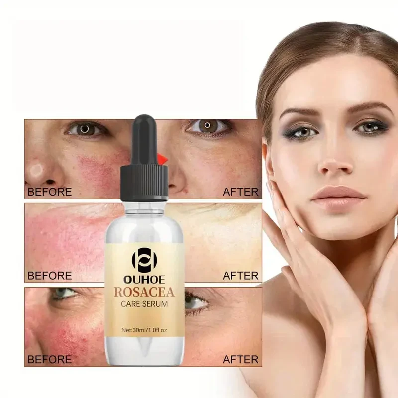 Suero para la rosácea OUHOE, 60 unidades, cuidado facial, aceites esenciales, hidrata y nutre, reduce el enrojecimiento de la piel, calma y elimina la piel escamosa, apto para todo tipo de piel, con glicerina, árbol de té, aloe vera y urea.