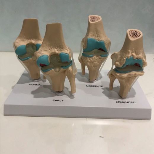 Modelo de articulación de rodilla enferma de cuatro etapas Modelo de articulación enferma