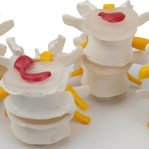 Equipo de enseñanza médica para modelo de columna lumbar con enfermedad de 4 etapas