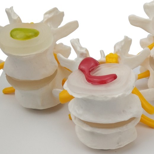 Equipo de enseñanza médica para modelo de columna lumbar con enfermedad de 4 etapas