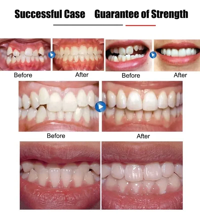 Elastics For Braces