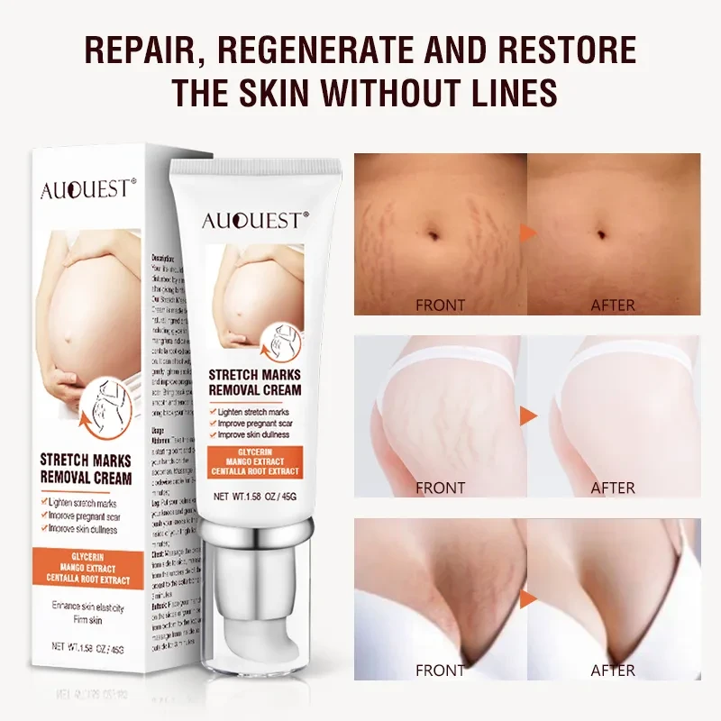 Remove Pregnancy Scars Acne Cream Stretch Mark Treatment Maternity Repair Anti-Aging Anti-Winkle Firming Body Cream