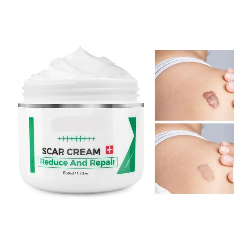 Scar Remover Paste Stretch Mark Burns