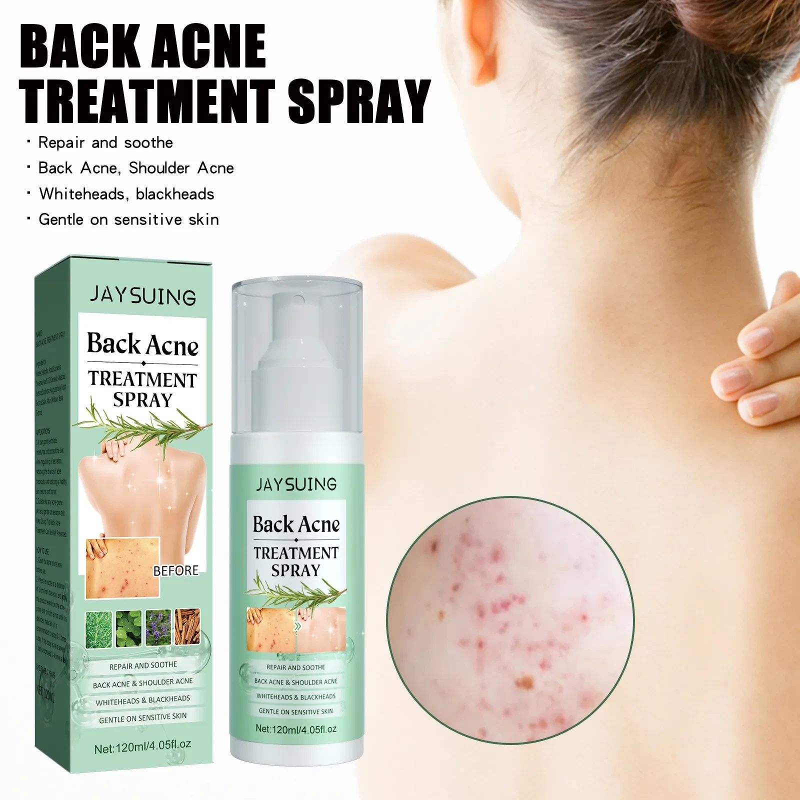 Back Acne Treatment Spray
