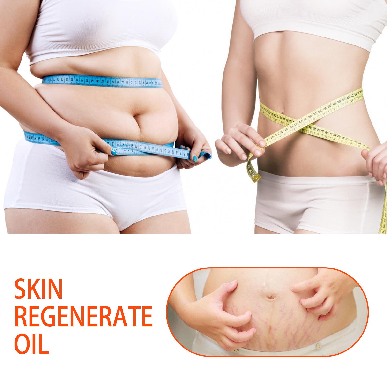 Jaysuing Skin Regenerate Oil – Stretch Mark & Scar Treatment