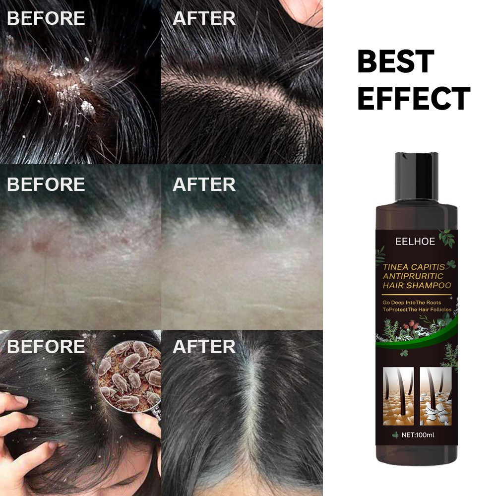EELHOE Plant Formula Antipruritic Hair Shampoo – Dandruff Control & Hair Follicle Protection