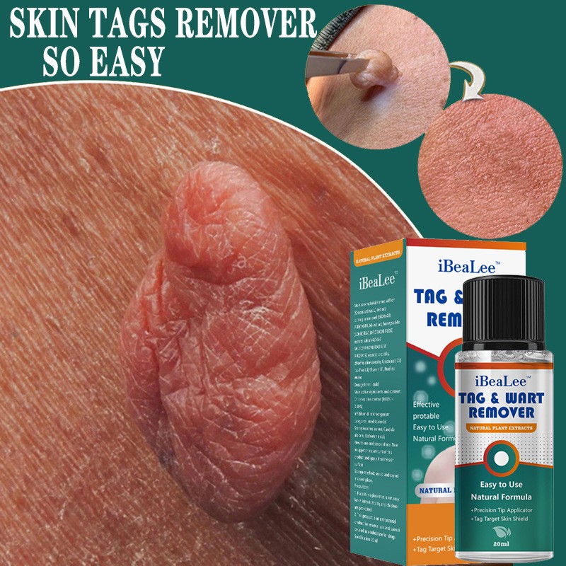 iBeaLee Skin Tag & Wart Remover