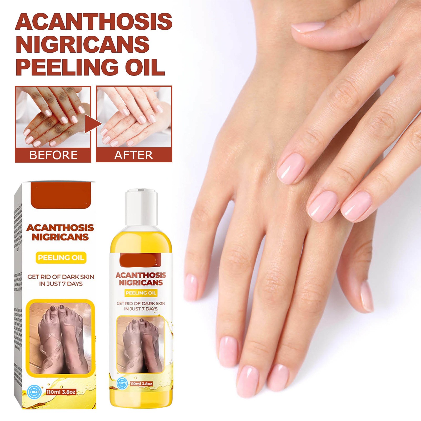 Acanthosis Nigricans Peeling Oil – Remove Dark Skin in Just 7 Days