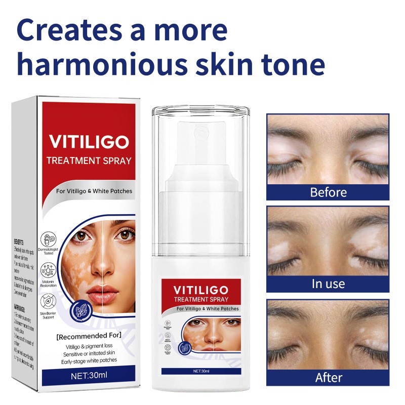 Vitiligo Treatment Spray