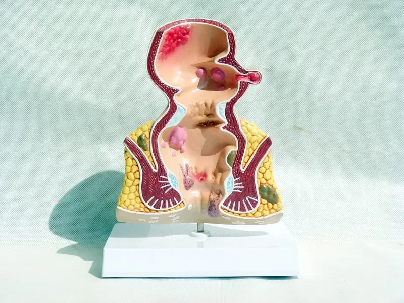 Enlarged Lung Alveoli Tissue Structure Model