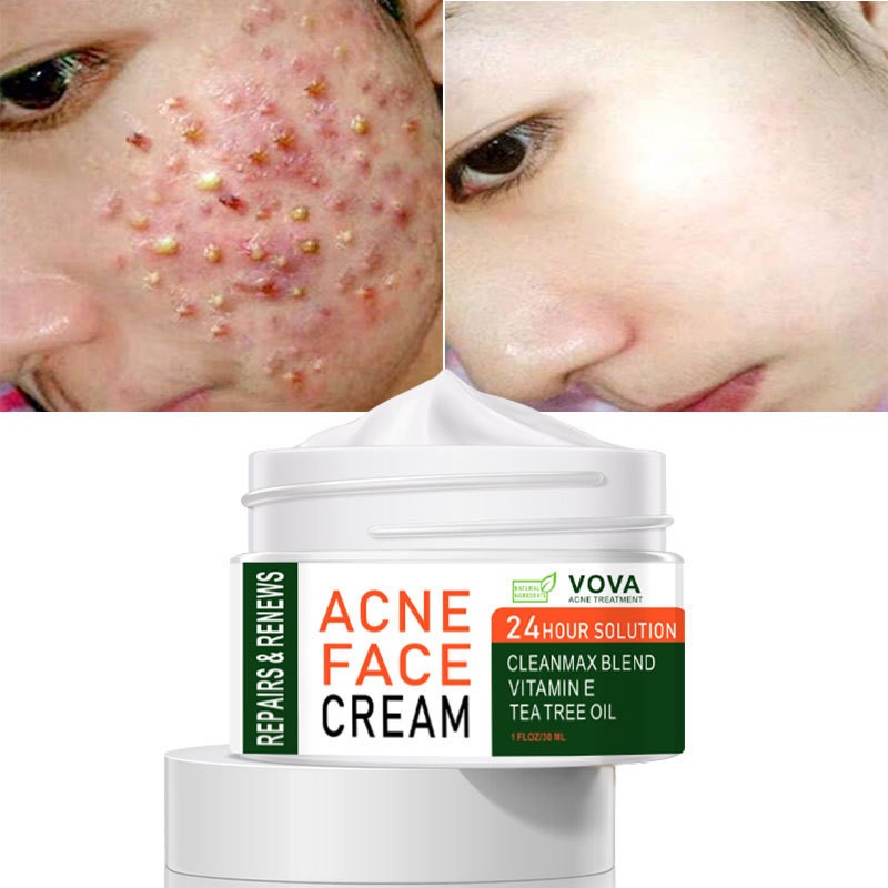 VOVA Acne Face Cream