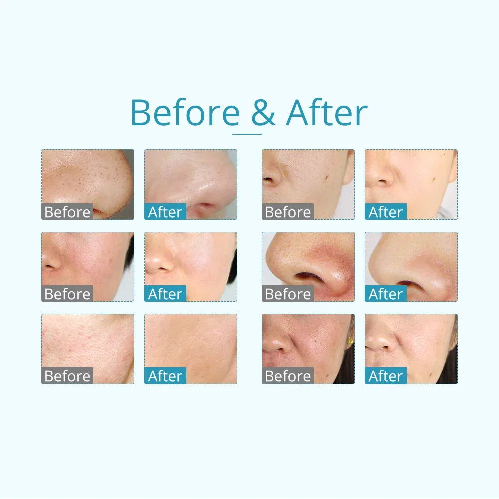 Color: White, Ships From: United States - 3 In 1 Vacuum Diamond Tip Microdermabrasion Machine Acne Blackhead Removal Skin Rejuvenation Water Spray Facial Beauty Machine