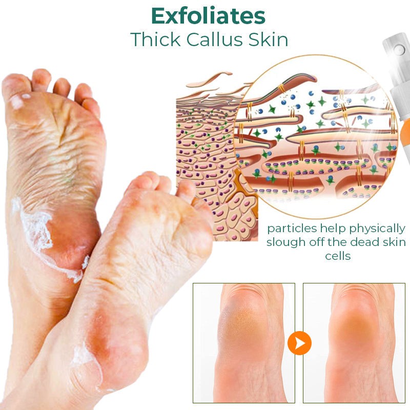 Foot Callus Removal Spray GFOUK™