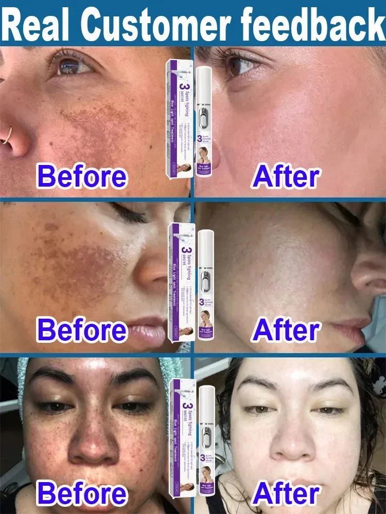 Color: green - ?…?«𝐞𝐜?¤𝐥𝐞 ?«𝐞?¦𝐨𝐯𝐚𝐥 Laser Therapy to Heal Spots