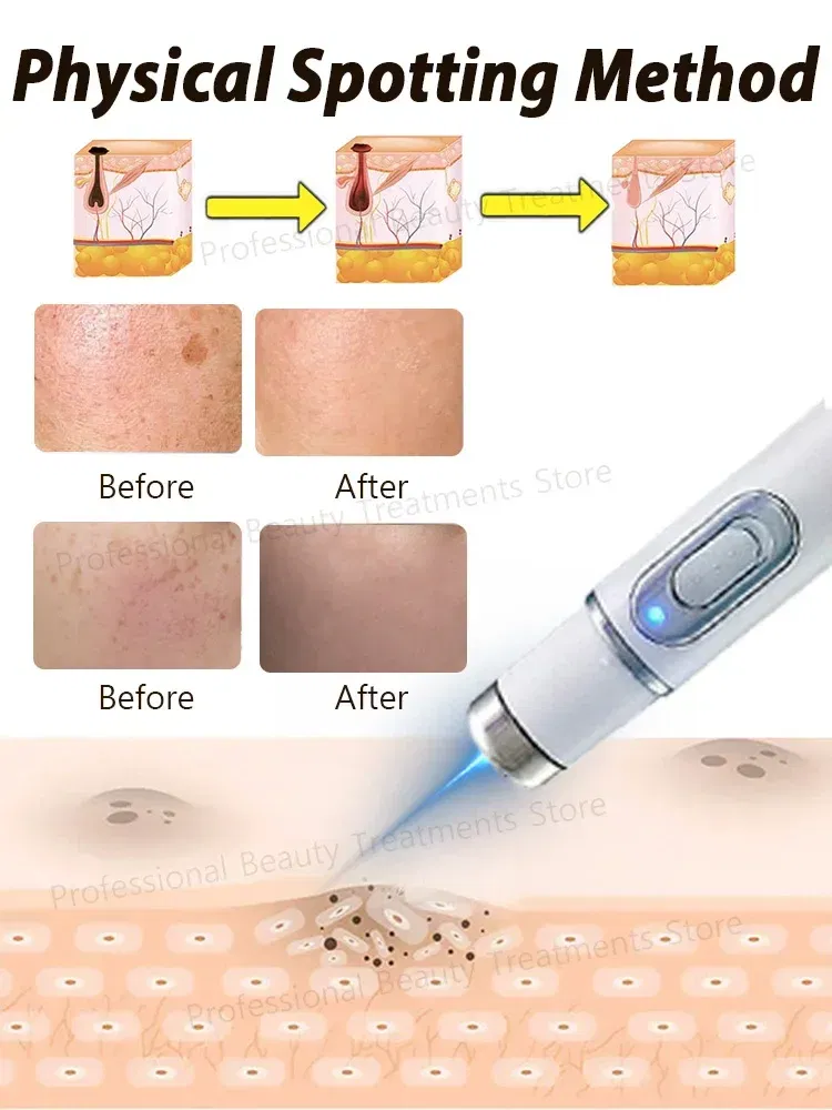 Color: green - ?…?«𝐞𝐜?¤𝐥𝐞 ?«𝐞?¦𝐨𝐯𝐚𝐥 Laser Therapy to Heal Spots