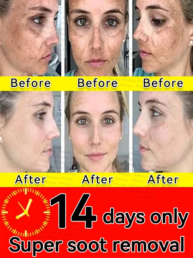 Color: green - ?…?«𝐞𝐜?¤𝐥𝐞 ?«𝐞?¦𝐨𝐯𝐚𝐥 Laser Therapy to Heal Spots