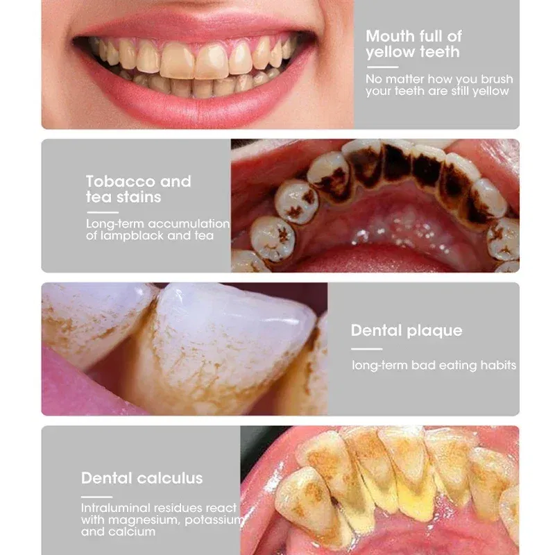 Color: Beige - Electric Toothbrush Sonic Dental Teeth Whitening Kit Tooth Whitener Calculus Tartar Remover Tools Cleaner Stain Oral Care