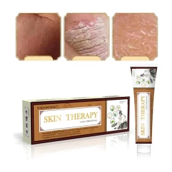 Psoriasis Cream Skin Skin care lotion