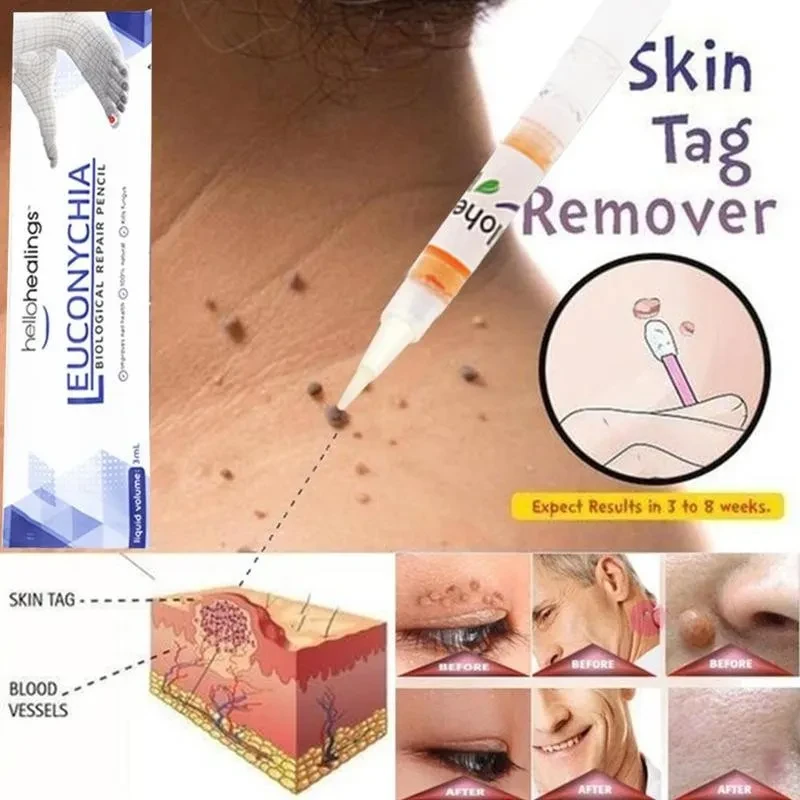 Skin Tag Remover