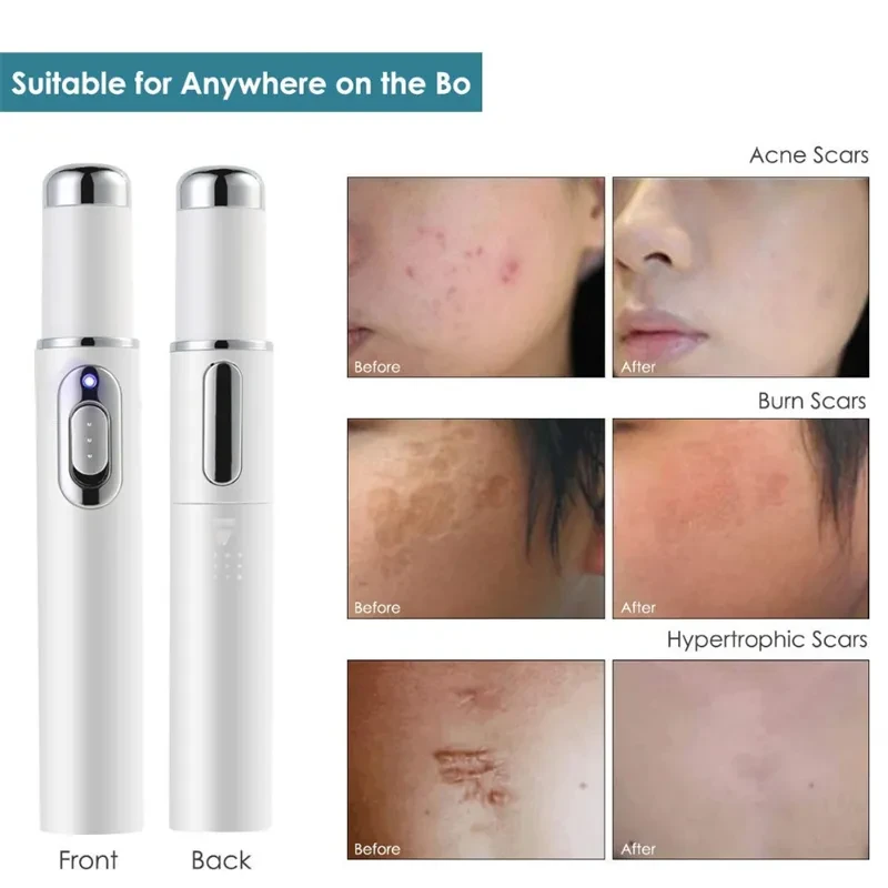 Blue Light Therapy Acne Laser Pen Soft Scar Wrinkle Removal