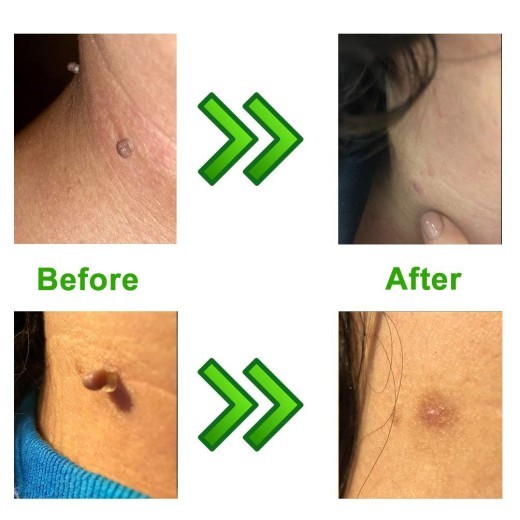 Skin Tag Removal Device, Meat Mole Removal, Corn Removal