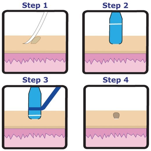 Skin Tag Removal Device, Meat Mole Removal, Corn Removal